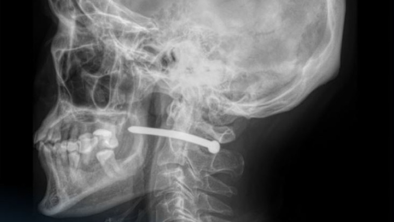 Гвоздь в шее: пневмопистолет стал орудием ремонта