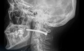 Гвоздь в шее: пневмопистолет стал орудием ремонта