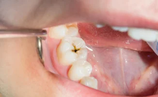 Учёные нашли простой способ защиты зубов от кариеса: исследование из Калифорнии