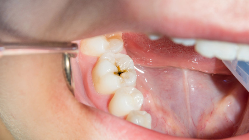 Учёные нашли простой способ защиты зубов от кариеса: исследование из Калифорнии