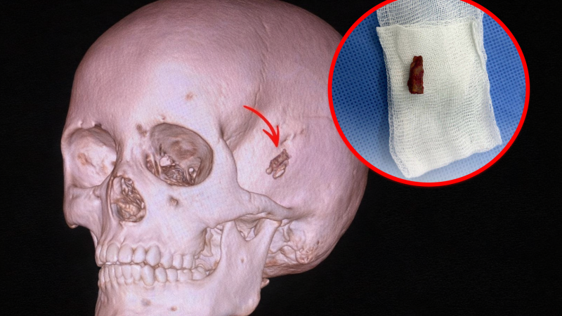 Школьник из Павлодара избавился от 5-летнего бремени: в голове нашли кусок дерева длиной почти 2 см