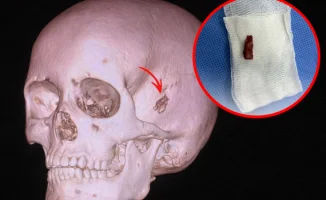 Школьник из Павлодара избавился от 5-летнего бремени: в голове нашли кусок дерева длиной почти 2 см