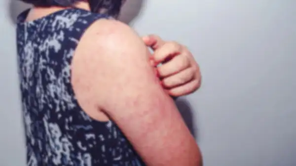 Увеличение случаев кори среди детей в Казахстане