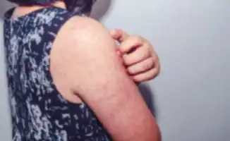 Увеличение случаев кори среди детей в Казахстане