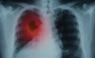 НДКТ-скрининг: ключ к ранней диагностике рака легкого