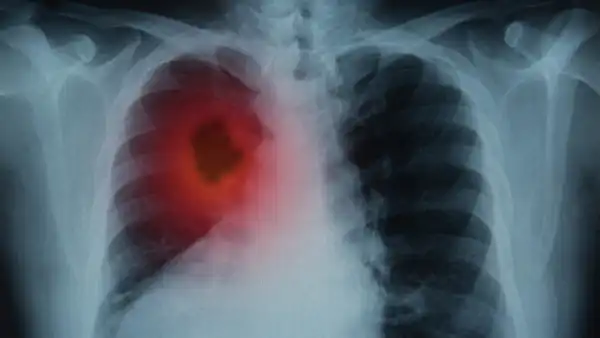 НДКТ-скрининг: ключ к ранней диагностике рака легкого