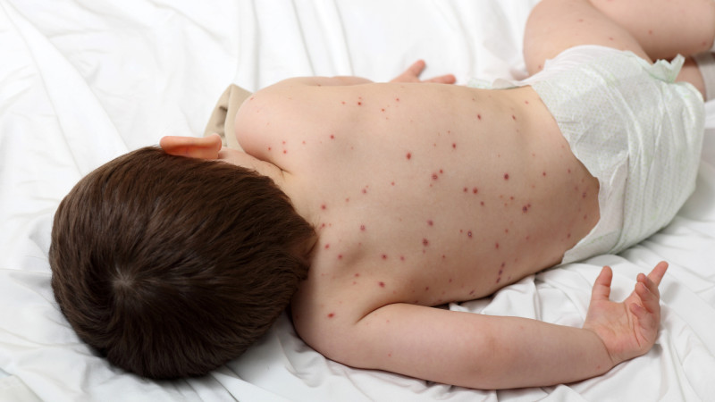 Казахстан снова сталкивается со вспышкой кори: третий случай с 2019 года