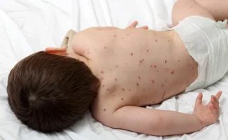 Казахстан снова сталкивается со вспышкой кори: третий случай с 2019 года