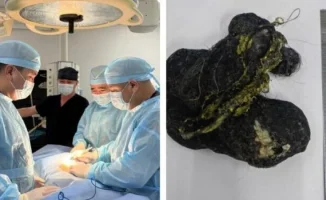 Шымкент: хирурги удалили 15 см ком волос из желудка ребенка