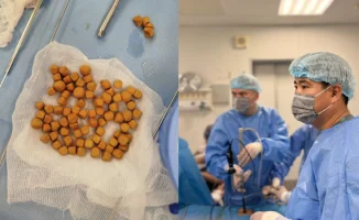 В Туркестане врачи извлекли 80 камней из мочевого пузыря 61-летнего казахстанца