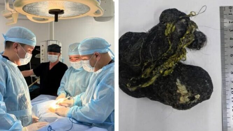 Шымкент: хирурги удалили 15 см ком волос из желудка ребенка