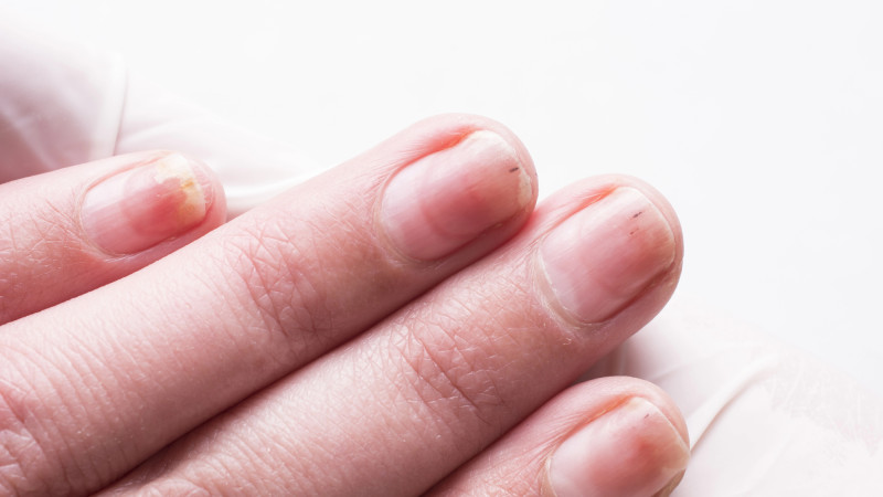 Симптомы рака: как распознать подногтевую опухоль в городе